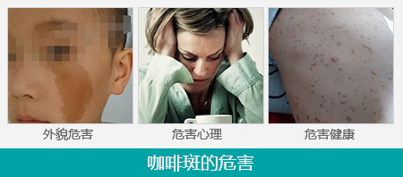 事实上,咖啡斑如果不及时治疗,可导致如神经纤维瘤,多发性雀斑样痣